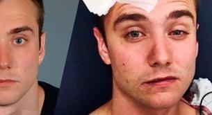 El youtuber Calum McSwiggan se inventa haber sido víctima de un ataque homófobo