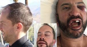 Brutal ataque homófobo a una pareja gay de vacaciones en Mykonos